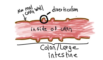 Diverticulosis/ Diverticulitis, what is it, and what is the difference